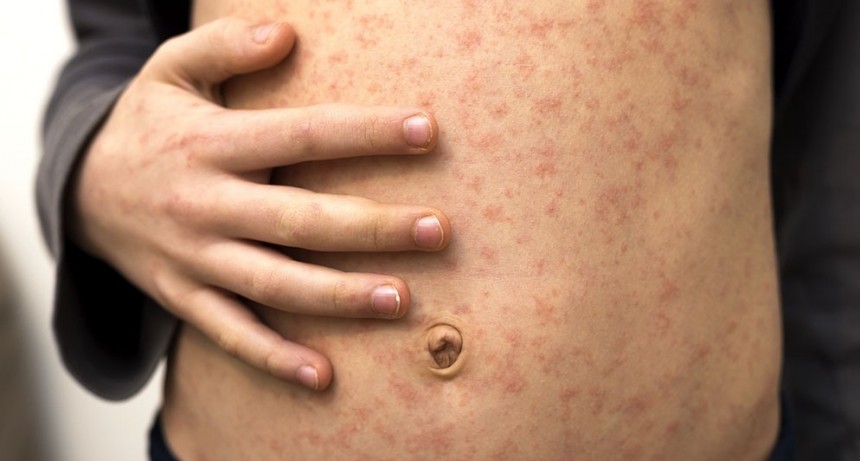 Sarampión: continúa el brote más extenso desde la eliminación de la circulación endémica